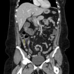 Appendicolith. CT Annotated 1. JETem 2026