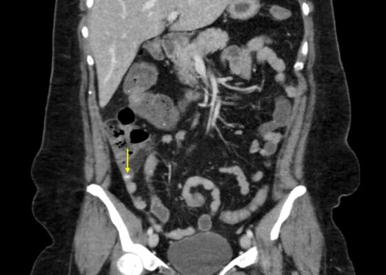 Appendicolith. CT Annotated 1. JETem 2026