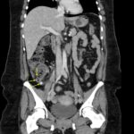 Appendicolith. CT Annotated 2. JETem 2026