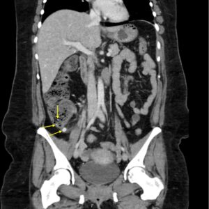 Appendicolith. CT Annotated 2. JETem 2026