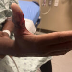 Cricket open fracture dislocation. Photo 1. JETem 2026