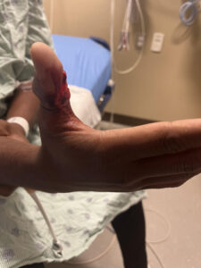 Cricket open fracture dislocation. Photo 1. JETem 2026