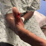 Cricket open fracture dislocation. Photo 2. JETem 2026