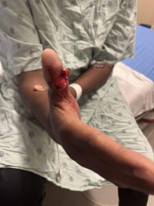 Cricket open fracture dislocation. Photo 2. JETem 2026