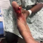 Cricket open fracture dislocation. Photo 3. JETem 2026