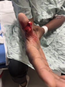 Cricket open fracture dislocation. Photo 3. JETem 2026