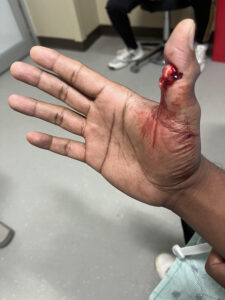 Cricket open fracture dislocation. Photo 4. JETem 2026