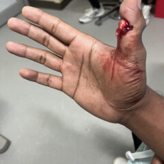 Cricket open fracture dislocation. Photo 4. JETem 2026