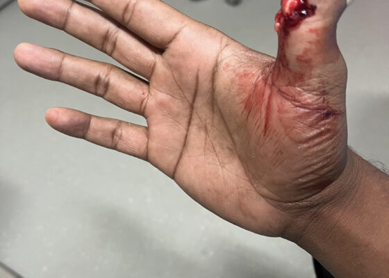 Cricket open fracture dislocation. Photo 4. JETem 2026