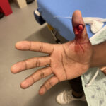 Cricket open fracture dislocation. Photo 5. JETem 2026