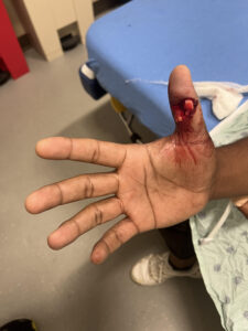 Cricket open fracture dislocation. Photo 5. JETem 2026