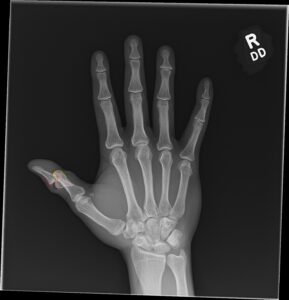 Cricket open fracture dislocation. XR AP Annotated. JETem 2026