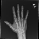 Cricket open fracture dislocation. XR AP. JETem 2026