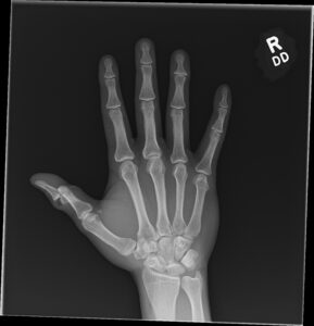 Cricket open fracture dislocation. XR AP. JETem 2026