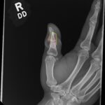 Cricket open fracture dislocation. XR Oblique Annotated. JETem 2026