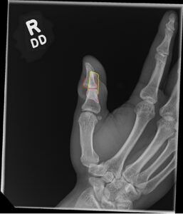 Cricket open fracture dislocation. XR Oblique Annotated. JETem 2026