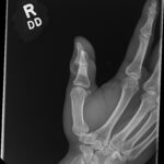 Cricket open fracture dislocation. XR Oblique. JETem 2026