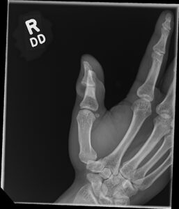 Cricket open fracture dislocation. XR Oblique. JETem 2026