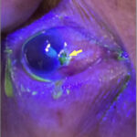 Open Globe Injury and Iris Prolapse. Fluoroscein exam Annotated. JETem 2026