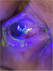 Open Globe Injury and Iris Prolapse. Fluoroscein exam Annotated. JETem 2026