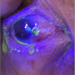 Open Globe Injury and Iris Prolapse. Fluoroscein exam. JETem 2026