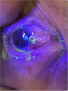 Open Globe Injury and Iris Prolapse. Fluoroscein exam. JETem 2026