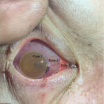 Open Globe Injury and Iris Prolapse. Photo Iris Prolapse Annotated. JETem 2026