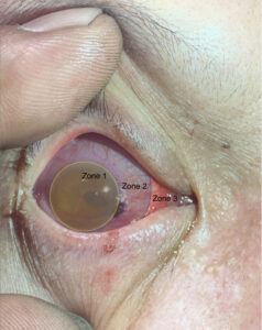 Open Globe Injury and Iris Prolapse. Photo Iris Prolapse Annotated. JETem 2026