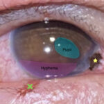 Open Globe Injury and Iris Prolapse. Photo Iris Prolapse close up Annotated. JETem 2026