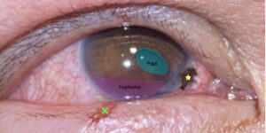 Open Globe Injury and Iris Prolapse. Photo Iris Prolapse close up Annotated. JETem 2026