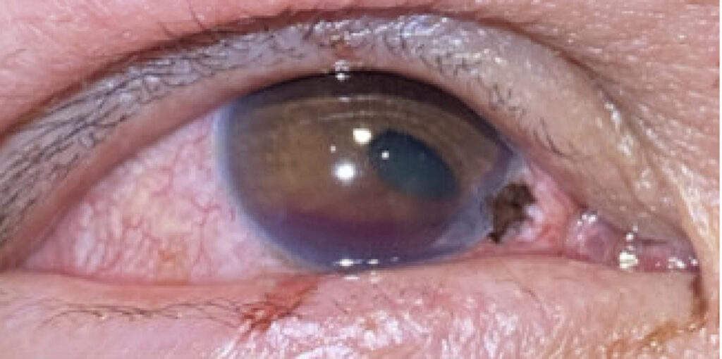 A Case Report of Corneoscleral Laceration with Open Globe Injury
