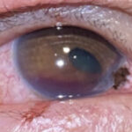Open Globe Injury and Iris Prolapse. Photo Iris Prolapse close up. JETem 2026