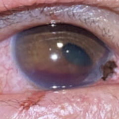 Open Globe Injury and Iris Prolapse. Photo Iris Prolapse close up. JETem 2026