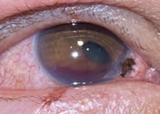 Open Globe Injury and Iris Prolapse. Photo Iris Prolapse close up. JETem 2026