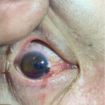 Open Globe Injury and Iris Prolapse. Photo Iris Prolapse. JETem 2026