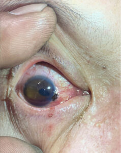 Open Globe Injury and Iris Prolapse. Photo Iris Prolapse. JETem 2026