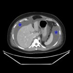 Ovary Hyperstim. CT Ascites Annotated. JETem 2026