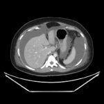 Ovary Hyperstim. CT Ascites Unannotated. JETem 2026