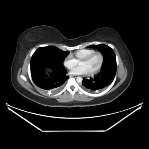 Ovary Hyperstim. CT Effusions Annotated. JETem 2026