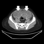 Ovary Hyperstim. CT OHSS Annotated. JETem 2026