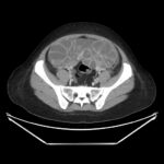 Ovary Hyperstim. CT OHSS Unannotated. JETem 2026