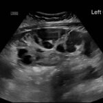 Ovary Hyperstim. Left Ovary US Annotated. JETem 2026