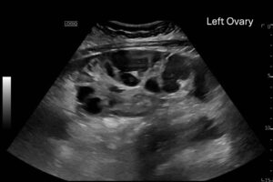 Ovary Hyperstim. Left Ovary US Annotated. JETem 2026