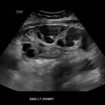 Ovary Hyperstim. Left Ovary US Unannotated. JETem 2026
