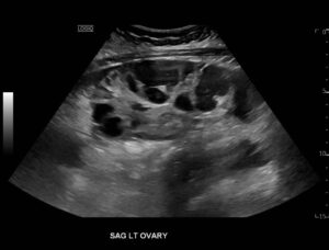 Ovary Hyperstim. Left Ovary US Unannotated. JETem 2026