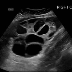Ovary Hyperstim. Right Ovary US Annotated. JETem 2026