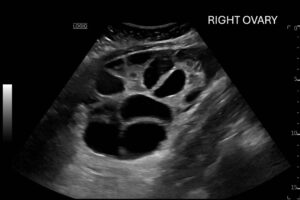 Ovary Hyperstim. Right Ovary US Annotated. JETem 2026