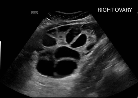 Ovary Hyperstim. Right Ovary US Annotated. JETem 2026