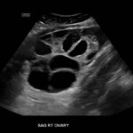 Ovary Hyperstim. Right Ovary US Unannotated. JETem 2026