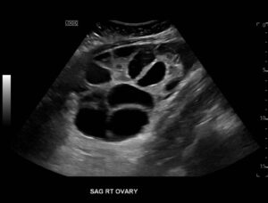 Ovary Hyperstim. Right Ovary US Unannotated. JETem 2026